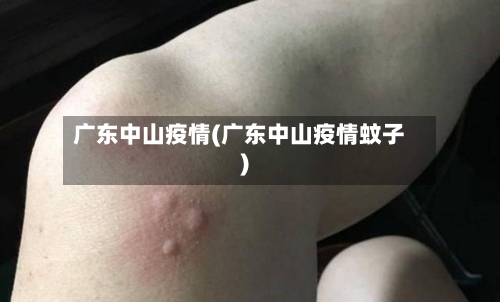 广东中山疫情(广东中山疫情蚊子)-第2张图片