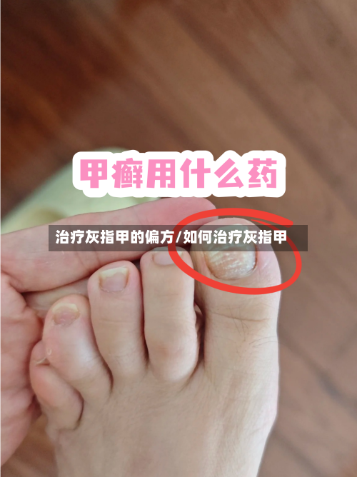 治疗灰指甲的偏方/如何治疗灰指甲-第1张图片